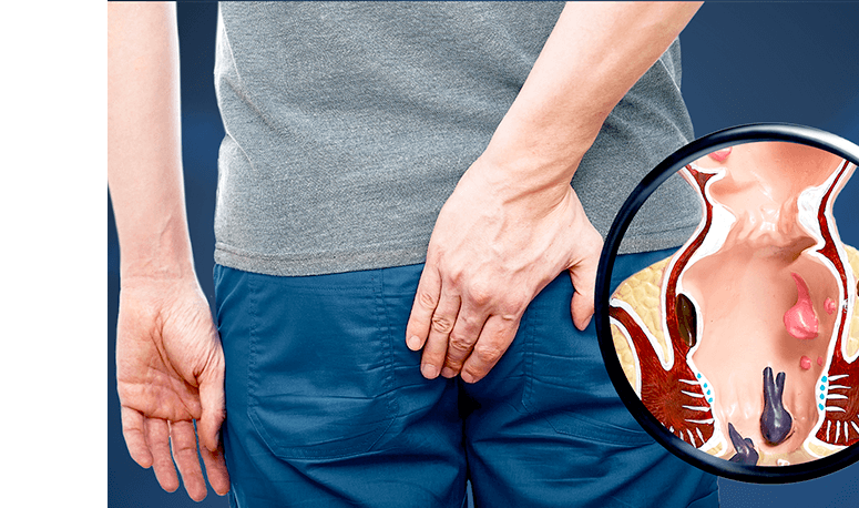 Anal Fistula Singapore