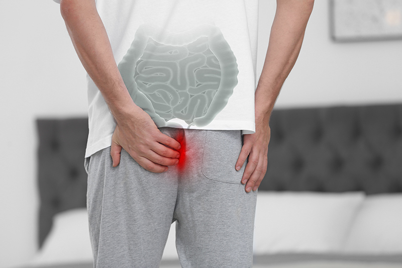 The Link Between Crohn’s Disease and Recurrent Anal Fistulas
