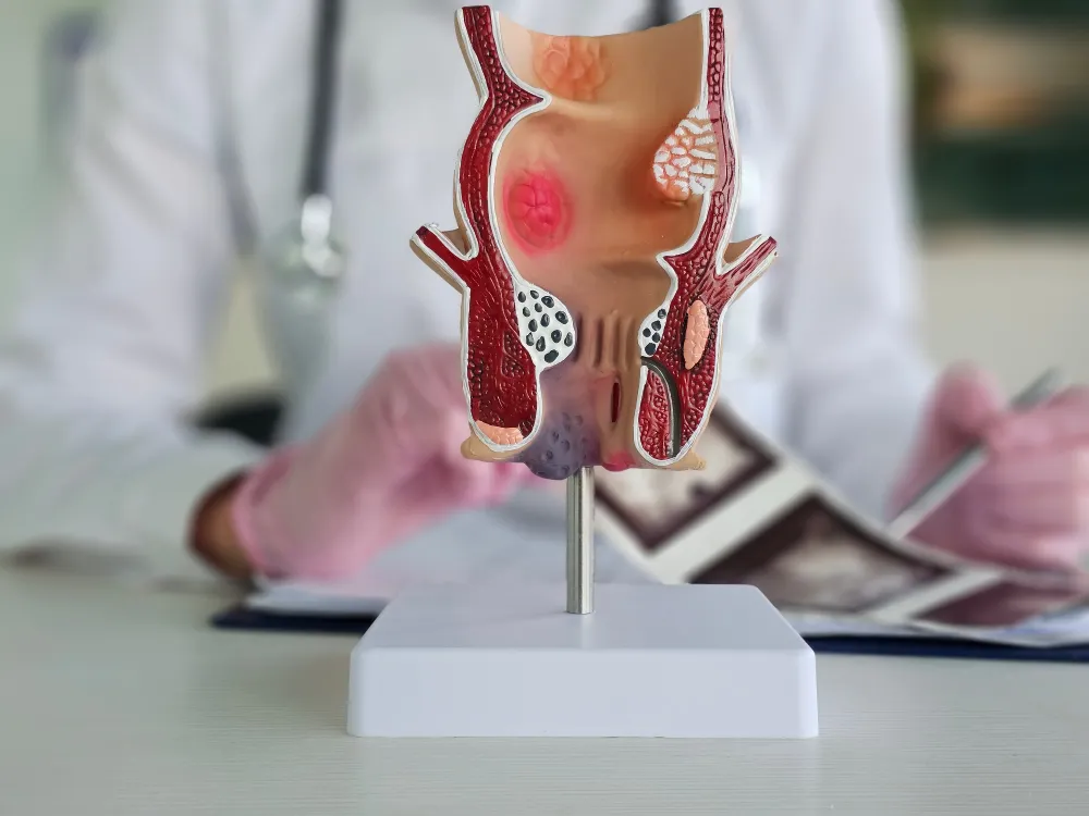 Complex Anal Fistula Treatment and Surgical Options
