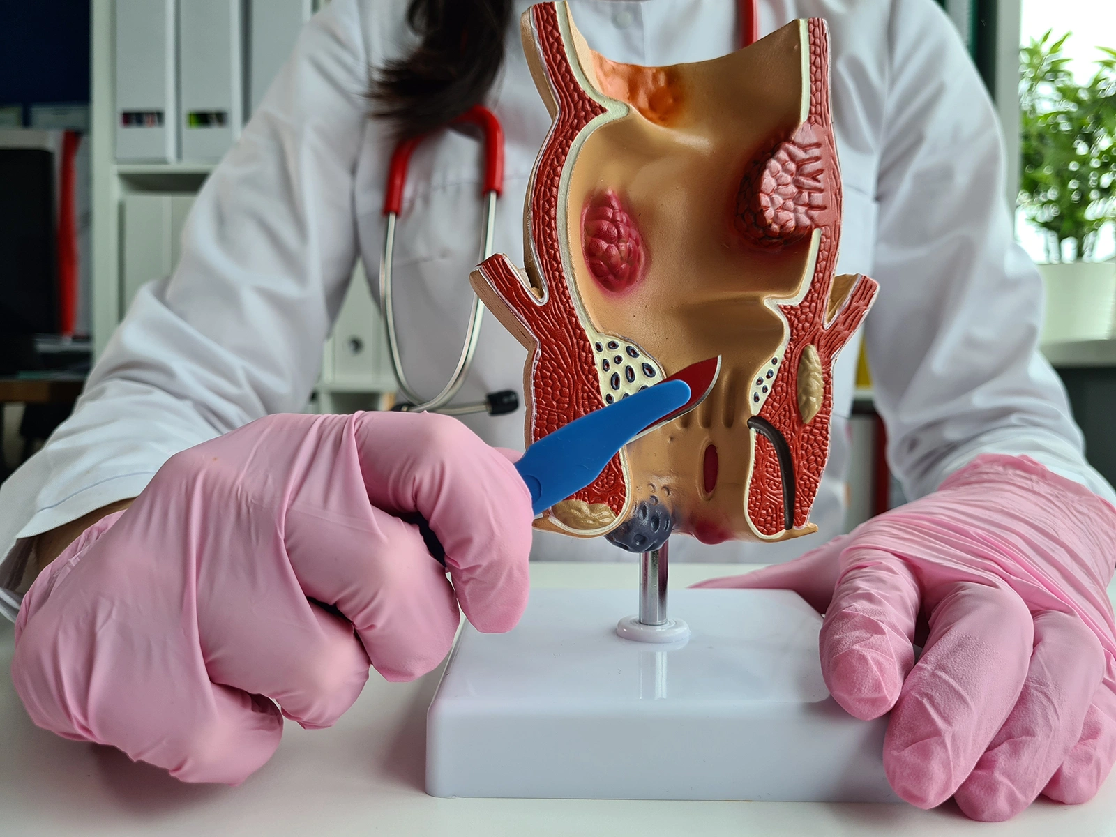 Minimally Invasive Treatments for Anal Fistula