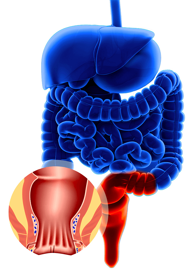 All About Anal Fistula