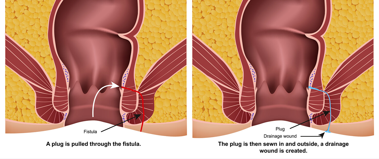 Common Anal Fistula Repair and Surgery Treatments